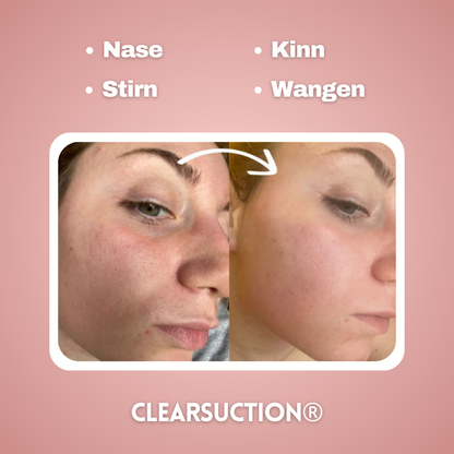 Lovelybeautys Clearsuction Pro® Porenreiniger